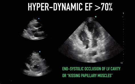 is hyperdynamic left ventricle serious